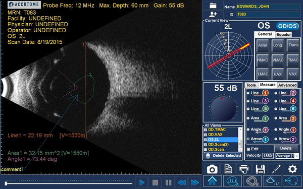 Аппарат УЗИ для аксиального сканирования 4Sight с датчиками А и B сканирования, пахиметрическим, UBM