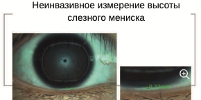 Высота слезного мениска